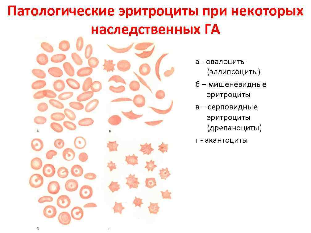 Эллиптоцитоз. Акантоциты это эритроциты. Патологические формы эритроцитов. Мишеневидные эритроциты. Патологические формы эритроциты крови.