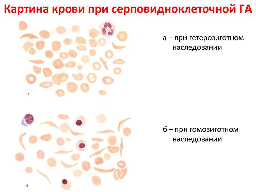 Картина крови при серповидноклеточной ГА а – при гетерозиготном наследовании б – при гомозиготном