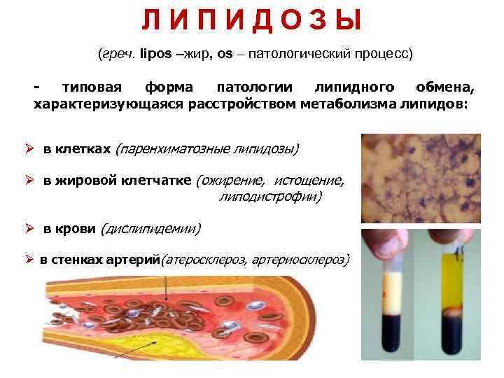 ЛИПИДОЗЫ (греч. lipos –жир, os – патологический процесс) типовая форма патологии липидного обмена, характеризующаяся