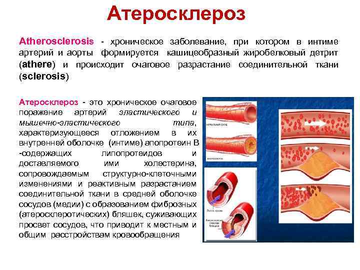 Атеросклероз патофизиология презентация