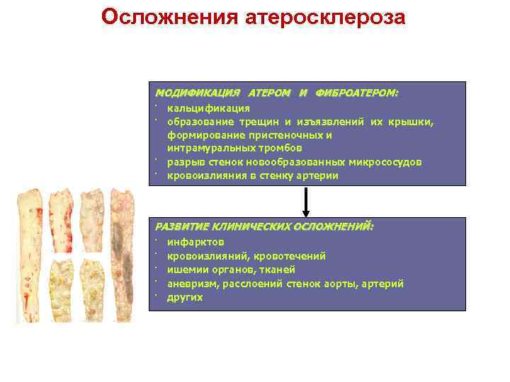 Атеросклероз аорты головного мозга. Осложнения атеросклероза. Осложнения атеросклероза аорты.