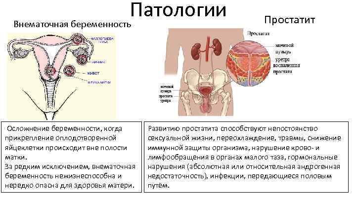 Патологии Внематочная беременность Осложнение беременности, когда прикрепление оплодотворенной яйцеклетки происходит вне полости матки. За