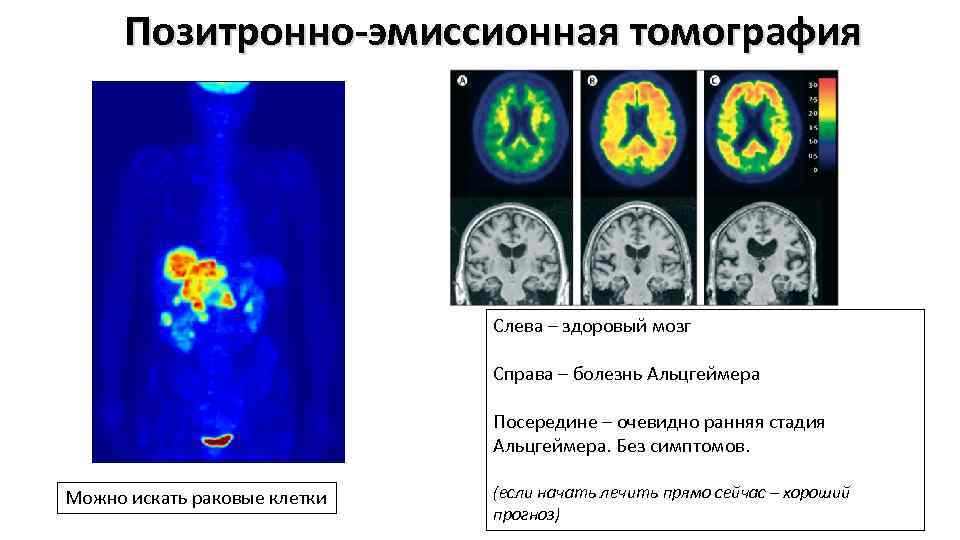 Позитронно эмиссионная томография презентация