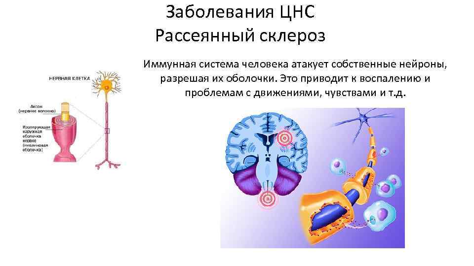 Заболевания нервной системы картинки