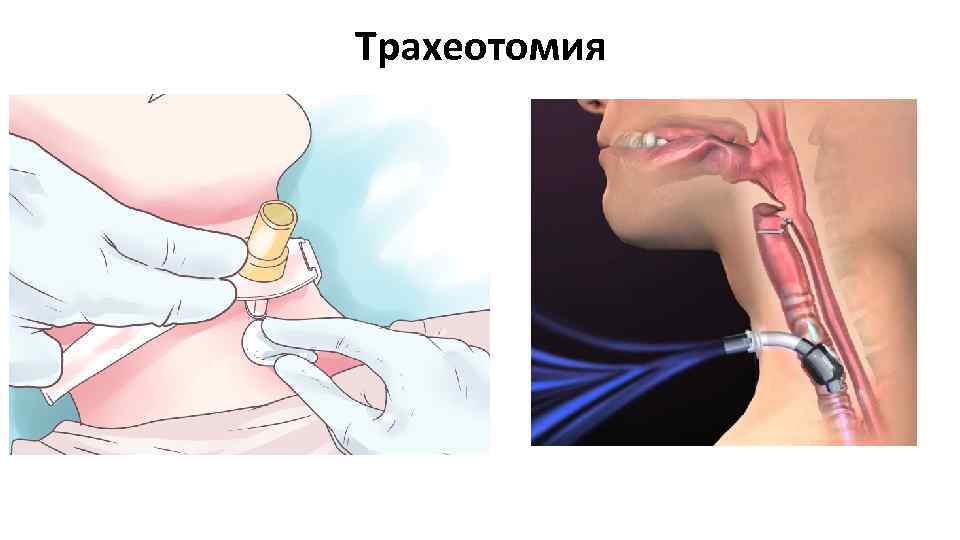 Трахеотомия 