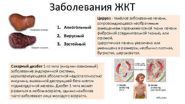 Заболевания ЖКТ 1. Алкогольный 2. Вирусный 3. Застойный Цирроз - тяжёлое заболевание печени, сопровождающееся
