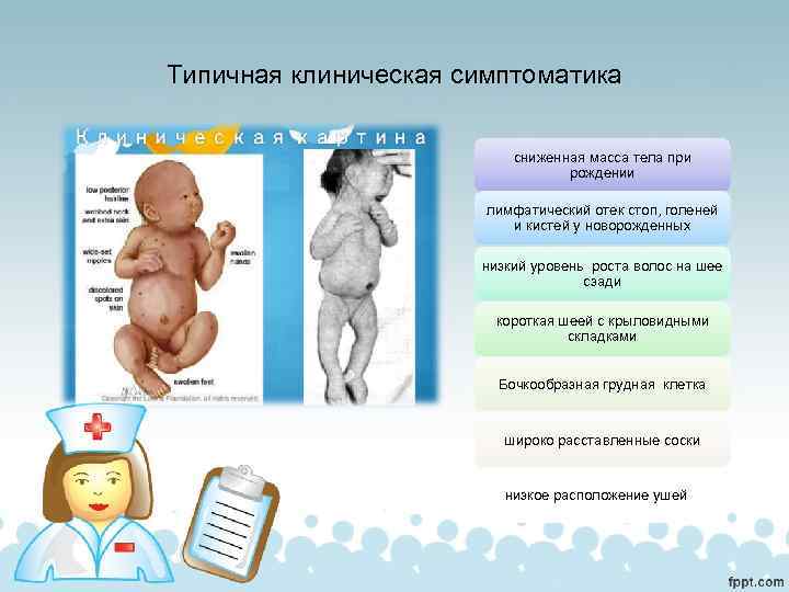 Типичная клиническая симптоматика сниженная масса тела при рождении лимфатический отек стоп, голеней и кистей