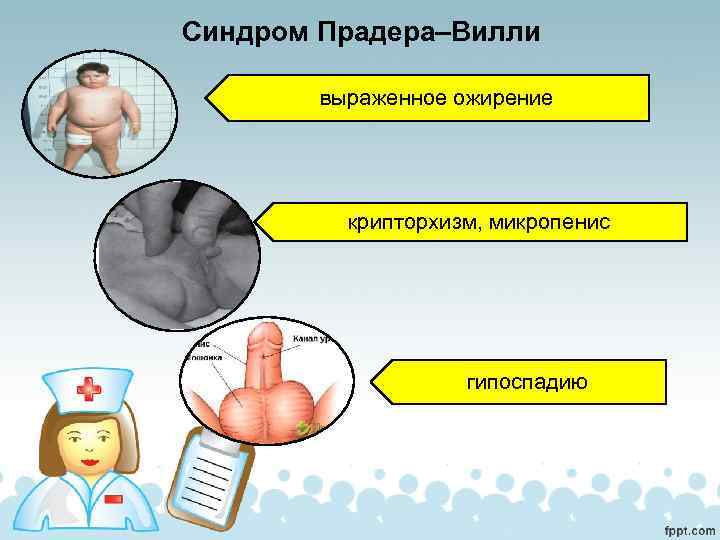 Синдром Прадера–Вилли выраженное ожирение крипторхизм, микропенис гипоспадию 