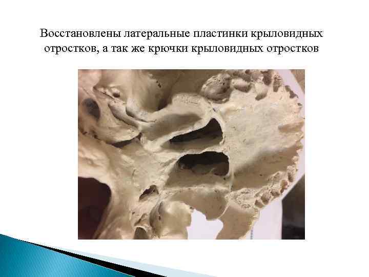 Восстановлены латеральные пластинки крыловидных отростков, а так же крючки крыловидных отростков 