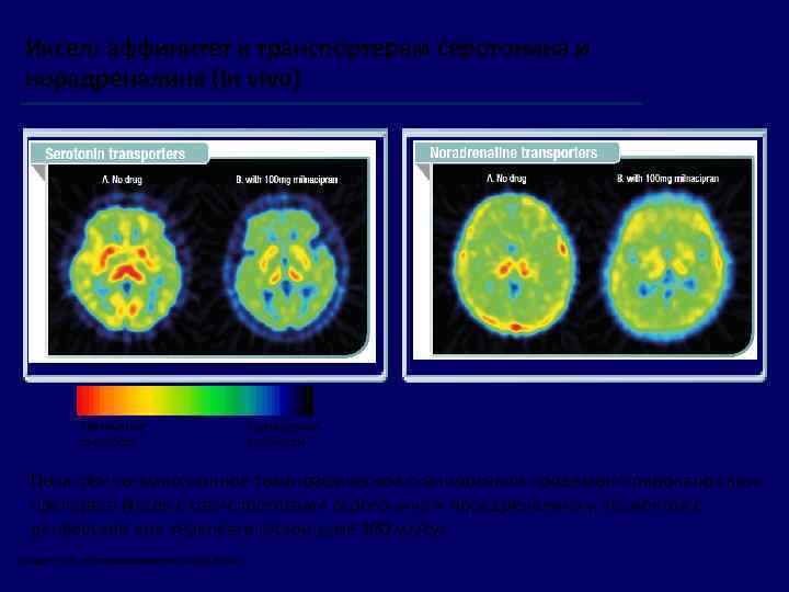 Иксел: аффинитет к транспортерам серотонина и норадреналина (In vivo) Увеличение плотности Уменьшение плотности Позитронно-эмиссионное