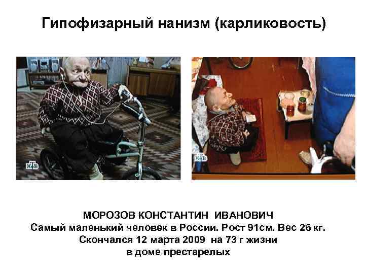 Гипофизарный нанизм (карликовость) МОРОЗОВ КОНСТАНТИН ИВАНОВИЧ Самый маленький человек в России. Рост 91 см.