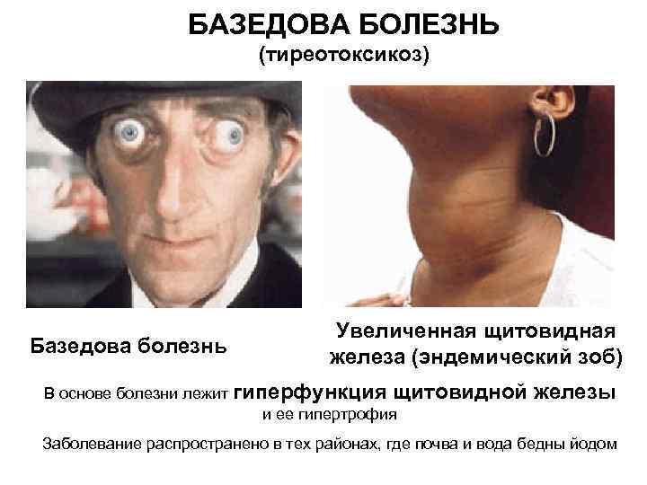 БАЗЕДОВА БОЛЕЗНЬ (тиреотоксикоз) Базедова болезнь Увеличенная щитовидная железа (эндемический зоб) В основе болезни лежит