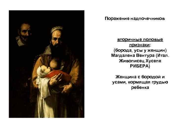 Поражение надпочечников вторичные половые признаки: (борода, усы у женщин) Магдалена Вентура (Итал. Живописец Хусепе