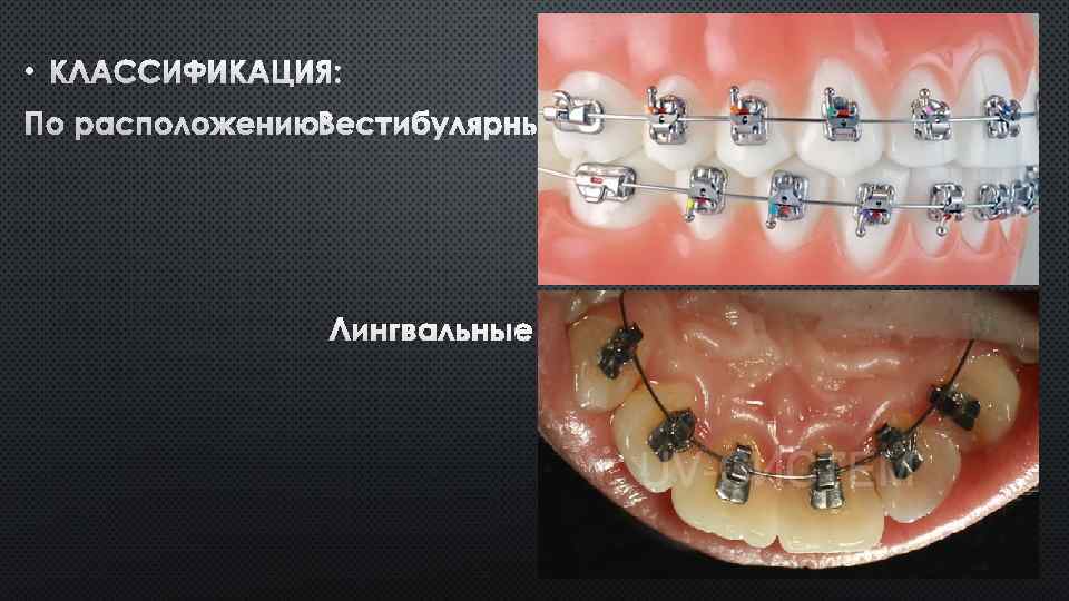  • КЛАССИФИКАЦИЯ: ПО РАСПОЛОЖЕНИЮ: ВЕСТИБУЛЯРНЫЕ ЛИНГВАЛЬНЫЕ 