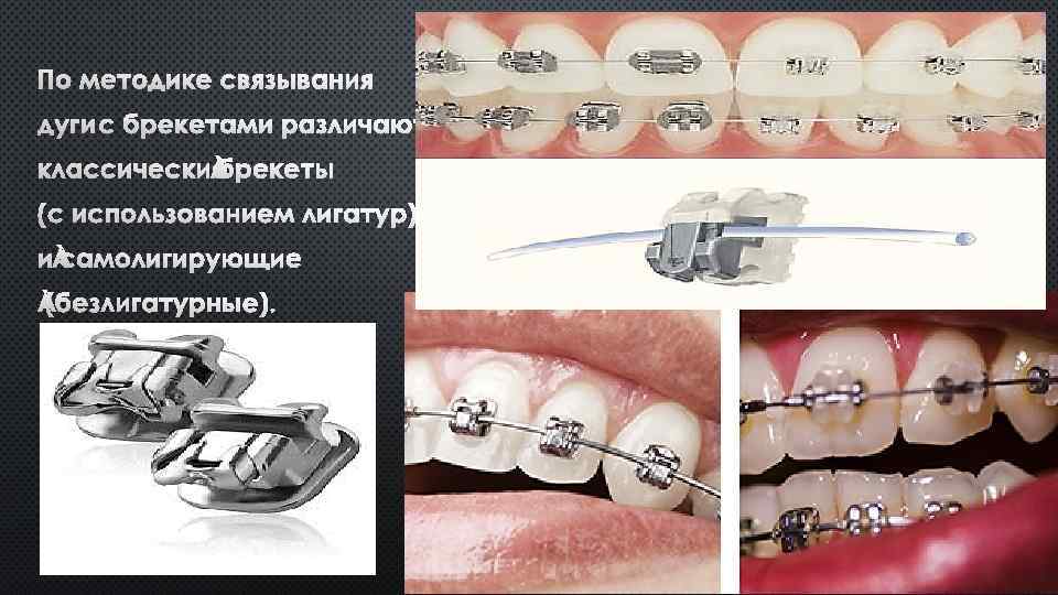 Лигатурные брекеты отзывы