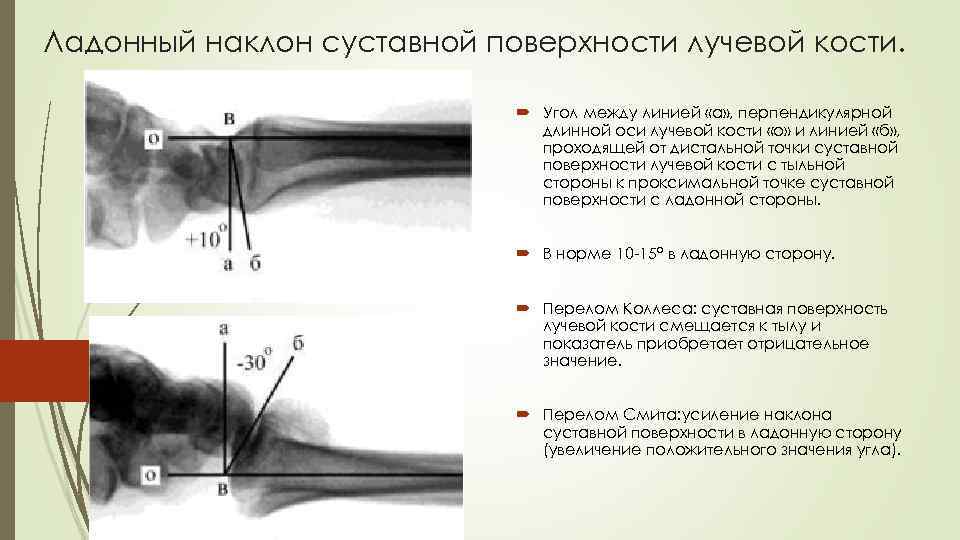 Ладонный наклон суставной поверхности лучевой кости. Угол между линией «а» , перпендикулярной длинной оси