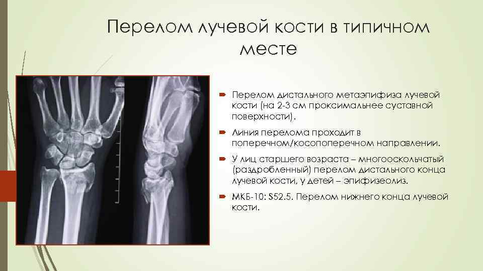 Перелом лучевой кости в типичном месте Перелом дистального метаэпифиза лучевой кости (на 2 -3
