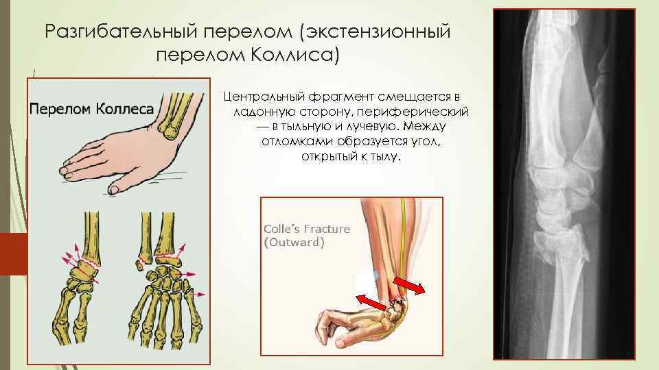 Перелом луча в типичном месте карта вызова