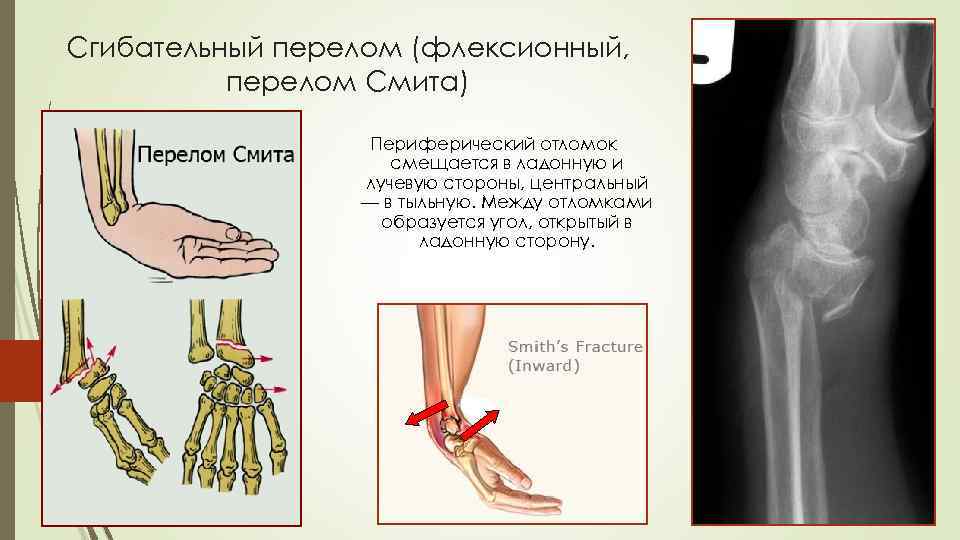 Переломы травматология презентация