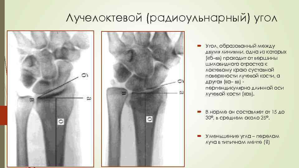 Лучелоктевой (радиоульнарный) угол Угол, образованный между двумя линиями, одна из которых ( «б–в» )
