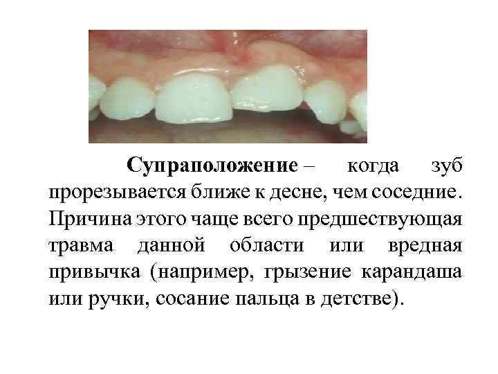  Супраположение – когда зуб прорезывается ближе к десне, чем соседние. Причина этого чаще