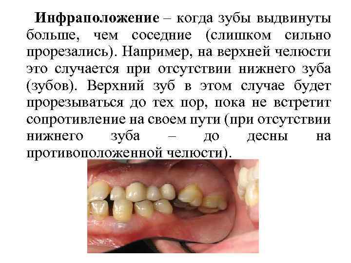  Инфраположение – когда зубы выдвинуты больше, чем соседние (слишком сильно прорезались). Например, на