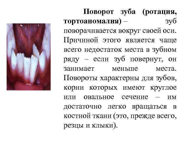  Поворот зуба (ротация, тортоаномалия) – зуб поворачивается вокруг своей оси. Причиной этого является