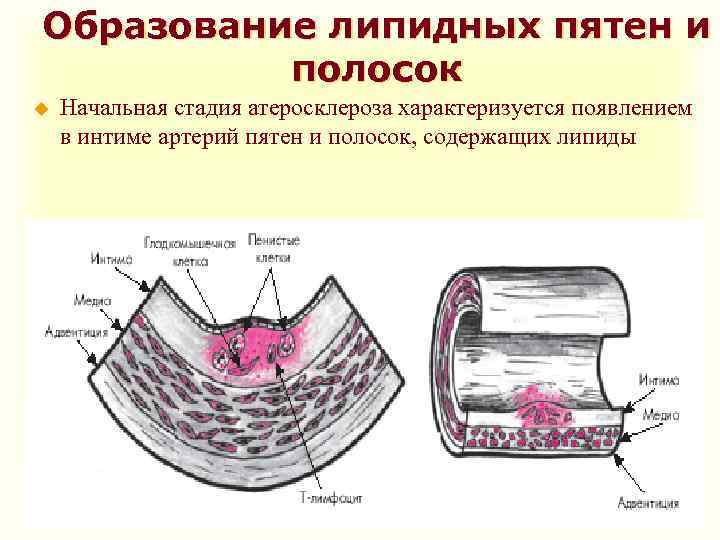 Образование липидных пятен и полосок u Начальная стадия атеросклероза характеризуется появлением в интиме артерий