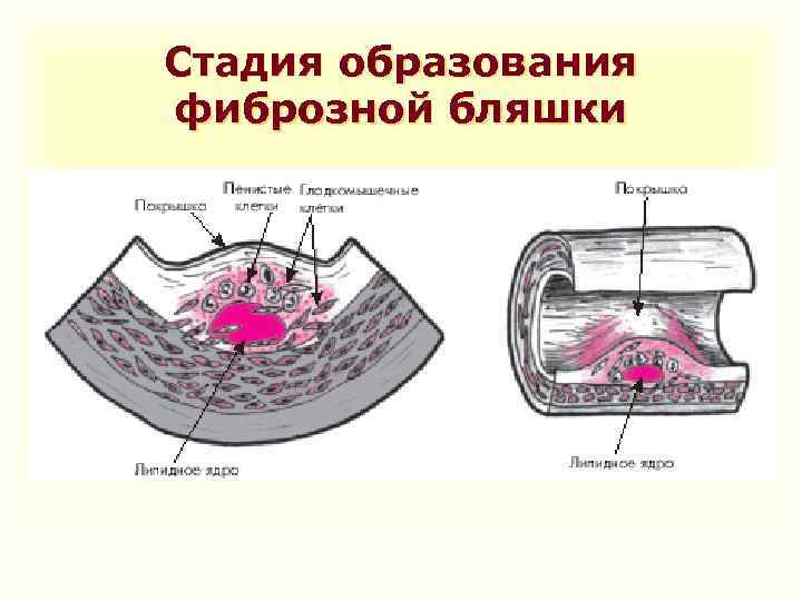 Стадия образования фиброзной бляшки 