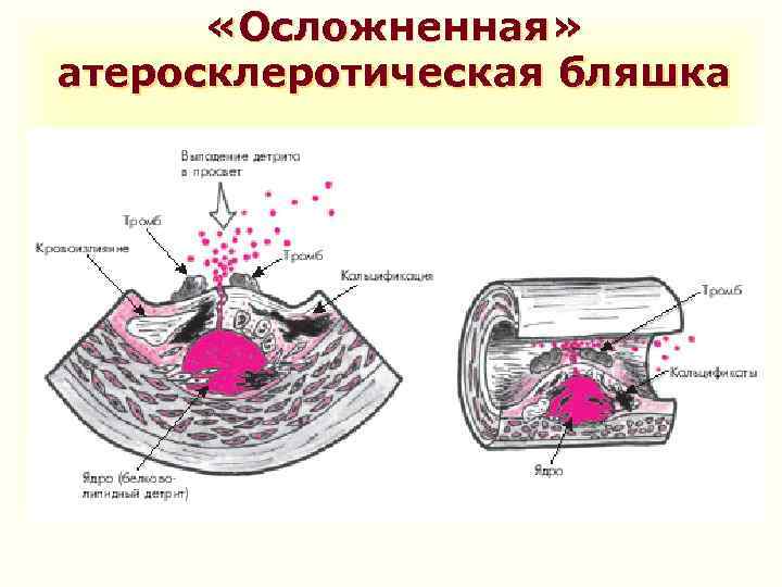  «Осложненная» атеросклеротическая бляшка 