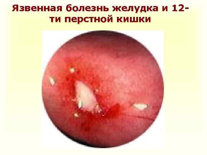 Язвенная болезнь желудка и 12 ти перстной кишки 