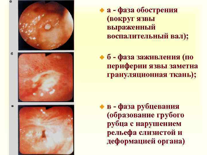 u а - фаза обострения (вокруг язвы выраженный воспалительный вал); u б - фаза