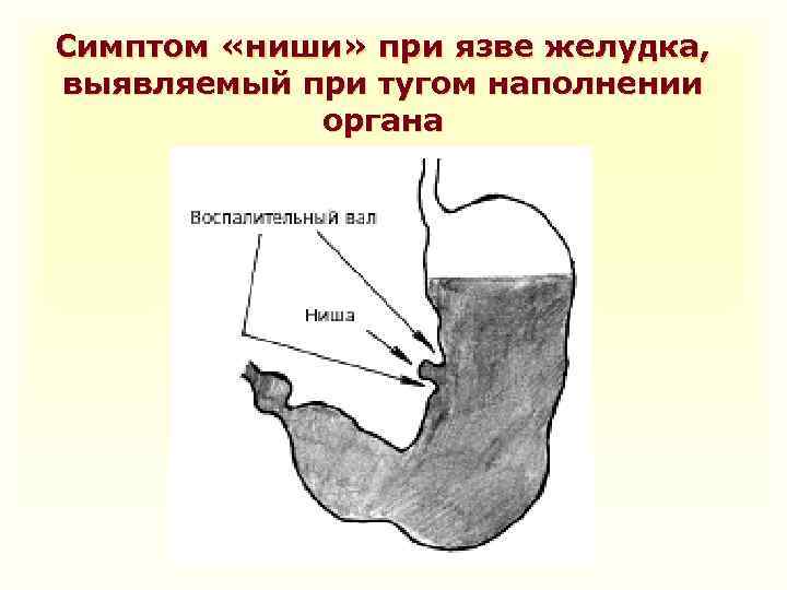 Симптом «ниши» при язве желудка, выявляемый при тугом наполнении органа 