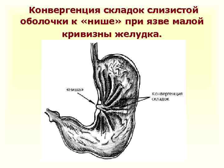 Конвергенция складок слизистой оболочки к «нише» при язве малой кривизны желудка. 