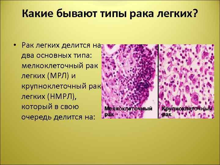 Какие бывают типы рака легких? • Рак легких делится на два основных типа: мелкоклеточный