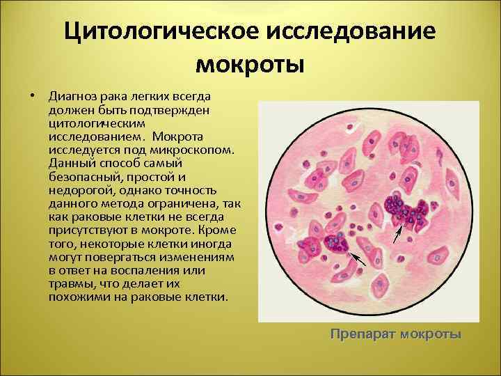 Цитологическое исследование мокроты • Диагноз рака легких всегда должен быть подтвержден цитологическим исследованием. Мокрота