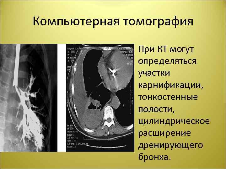 Компьютерная томография • При КТ могут определяться участки карнификации, тонкостенные полости, цилиндрическое расширение дренирующего