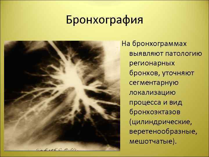 Бронхография На бронхограммах выявляют патологию регионарных бронхов, уточняют сегментарную локализацию процесса и вид бронхоэктазов