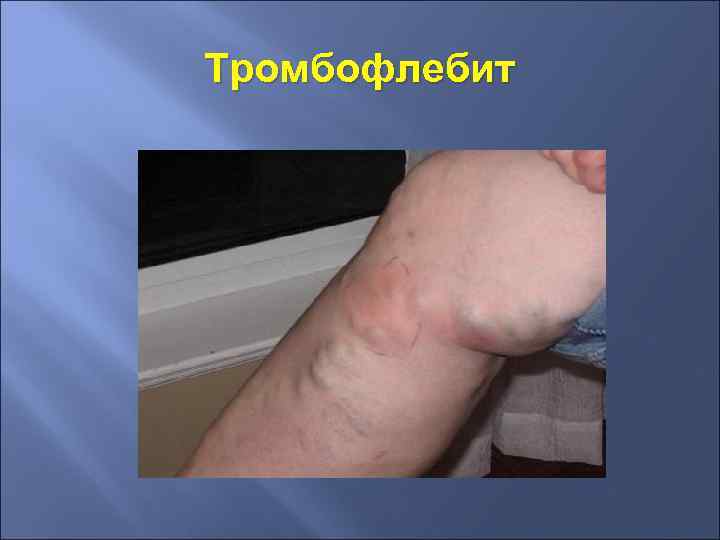 Тромбофлебит 
