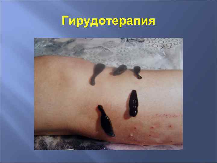 Гирудотерапия 