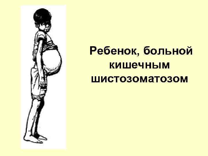  Ребенок, больной кишечным шистозоматозом 