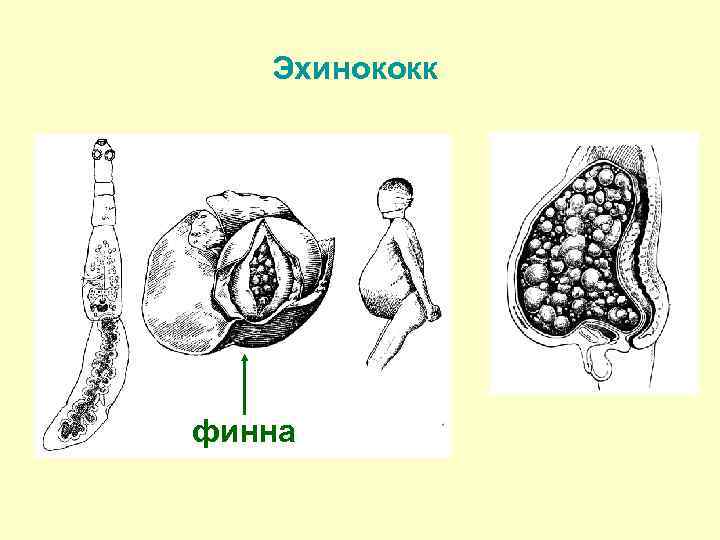 Эхинококк финна 