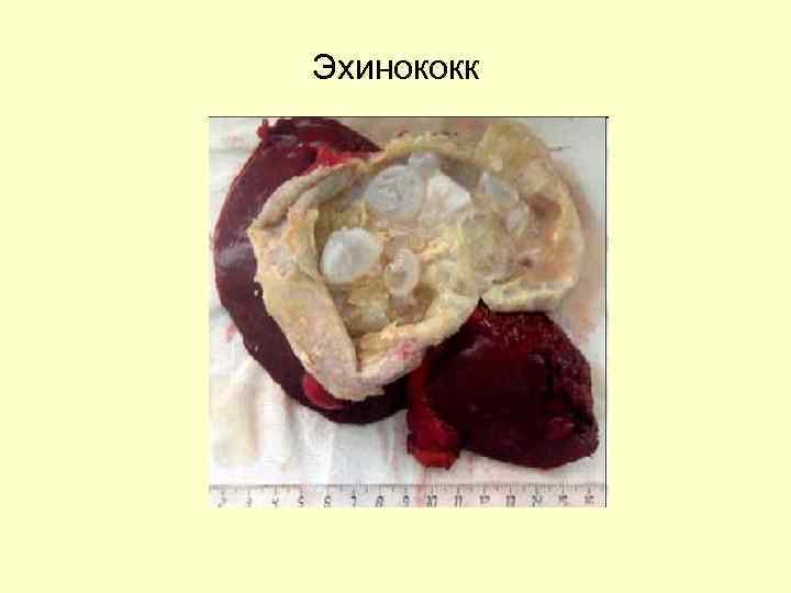 Эхинококк 