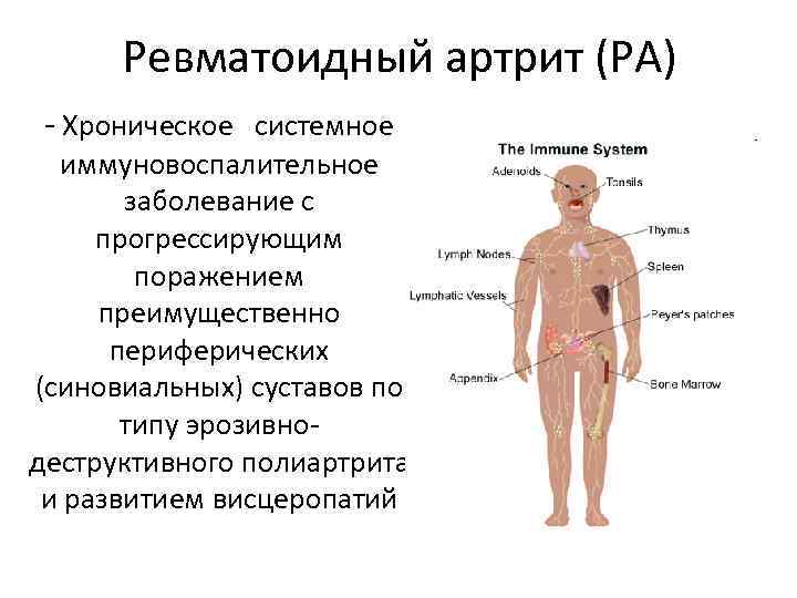 Ревматоидный артрит (РА) - Хроническое системное иммуновоспалительное заболевание с прогрессирующим поражением преимущественно периферических (синовиальных)