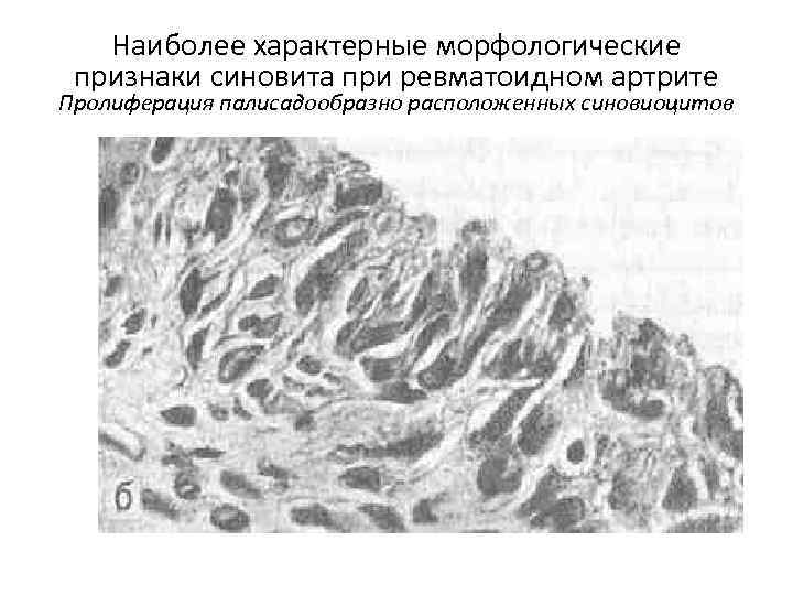 Наиболее характерные морфологические признаки синовита при ревматоидном артрите Пролиферация палисадообразно расположенных синовиоцитов 