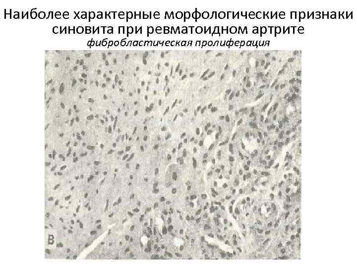 Наиболее характерные морфологические признаки синовита при ревматоидном артрите фибробластическая пролиферация 
