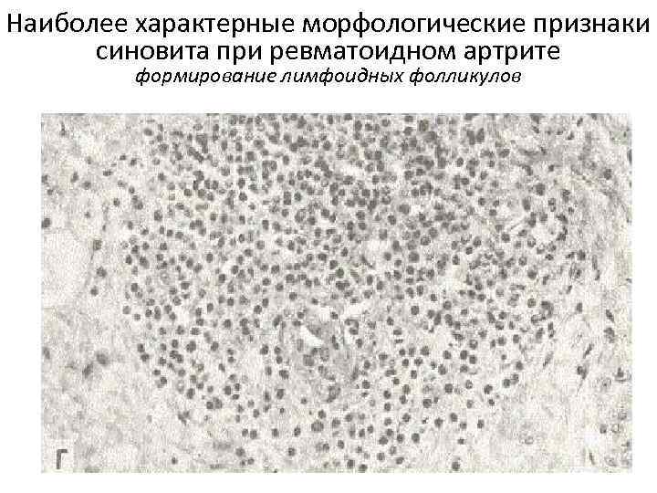 Наиболее характерные морфологические признаки синовита при ревматоидном артрите формирование лимфоидных фолликулов 