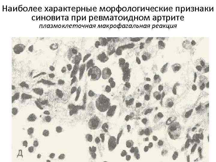 Наиболее характерные морфологические признаки синовита при ревматоидном артрите плазмоклеточная макрофагальная реакция 