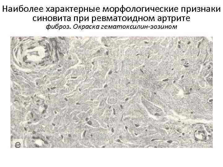 Наиболее характерные морфологические признаки синовита при ревматоидном артрите фиброз. Окраска гематоксилин-эозином 