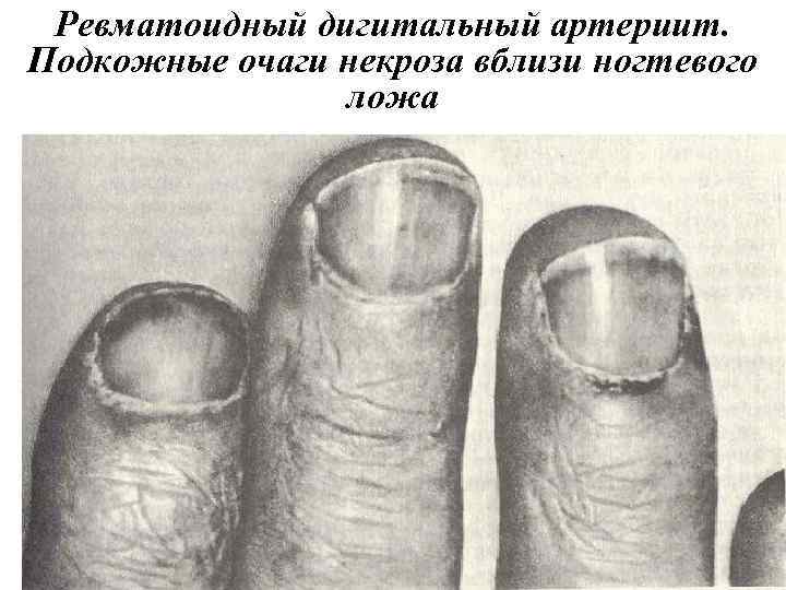 Ревматоидный дигитальный артериит. Подкожные очаги некроза вблизи ногтевого ложа 